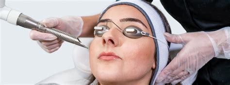 discomfort caused by bright lights or glare. YAG laser capsulotomy is a treatment that is used to make an opening in the capsule to allow light to pass through to the back of the eye and help improve your vision. The treatment is routinely done as an outpatient procedure, typically lasts under 15 minutes and involves no surgical cuts.